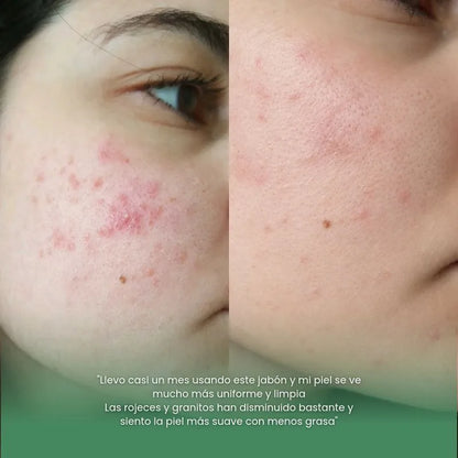 Jabón facial con ácido salicílico + ácilo kójico